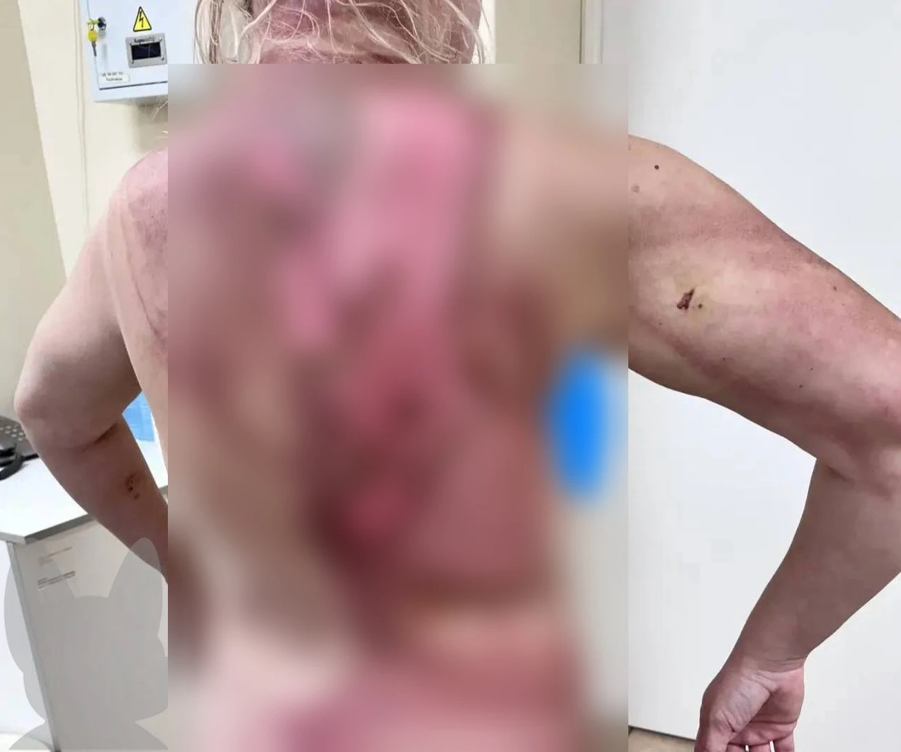 😡 В Балашихе женщину облили кипятком, а полиция отправляет её из города в город