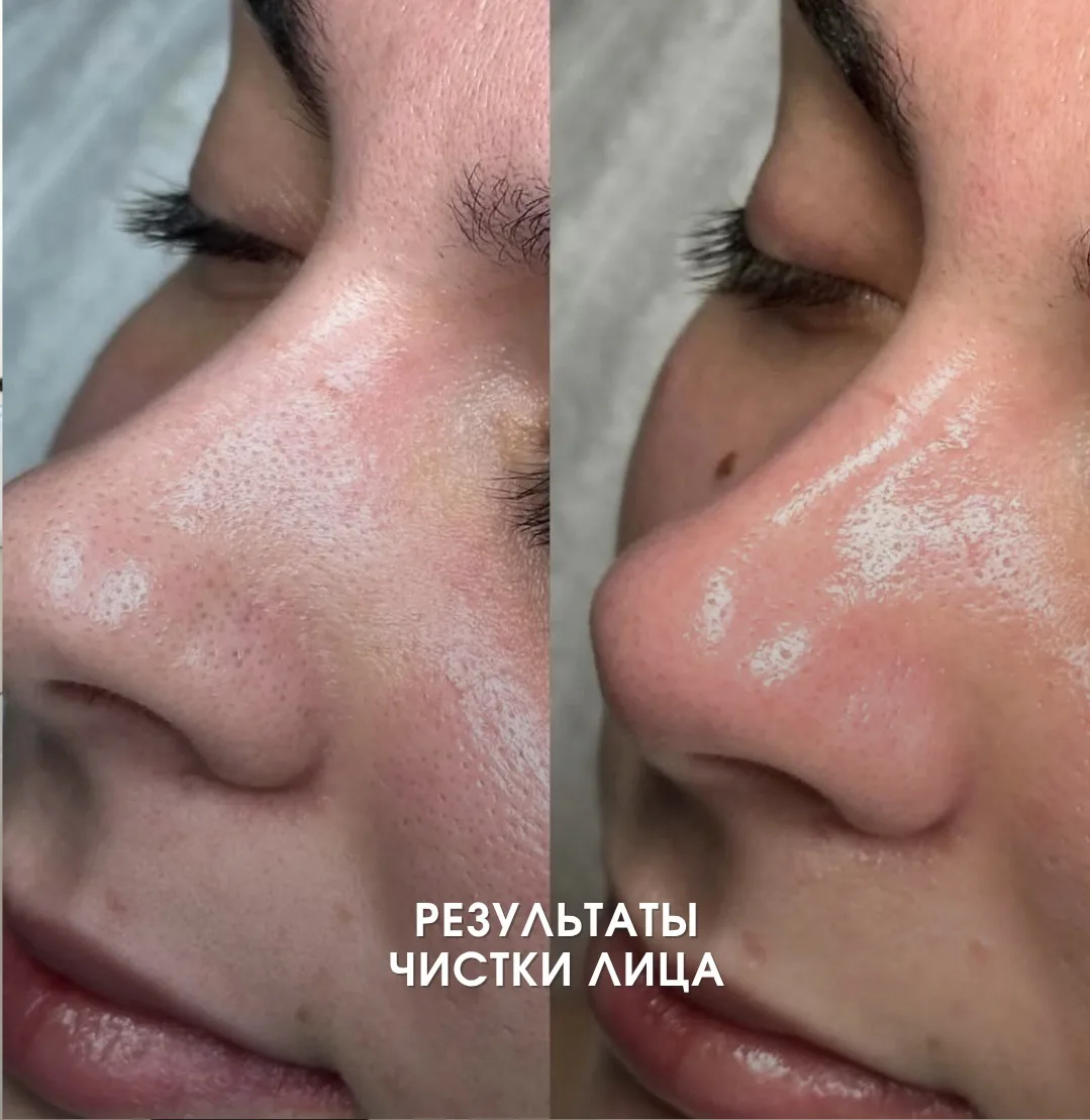 👆🏻Результаты после процедуры чистки лица