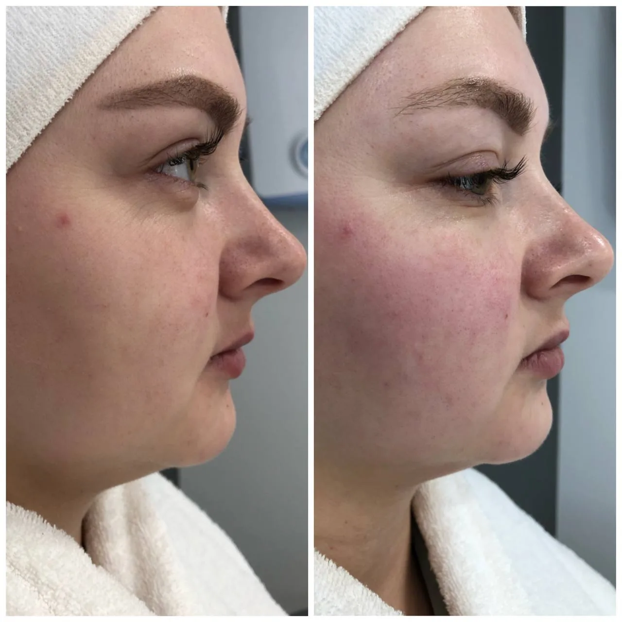 ✨ FORMA - подтяжка, которую вы почувствуете как SPA