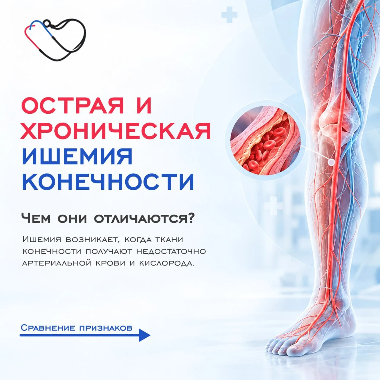 Острая и хроническая ишемия конечности: почему важно различать эти состояния?