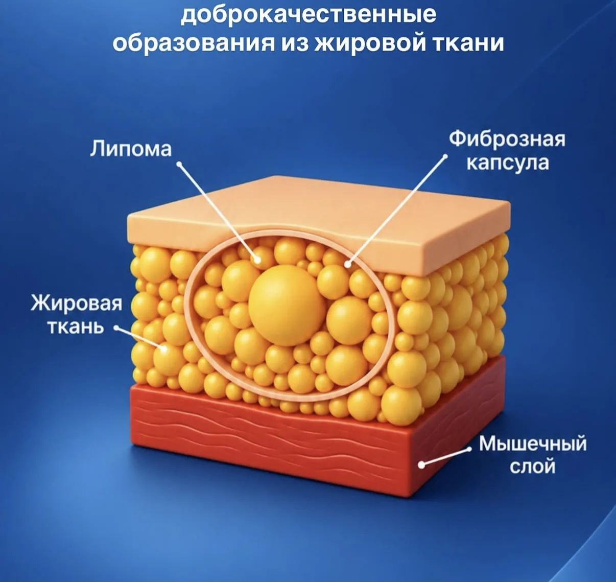 #липома