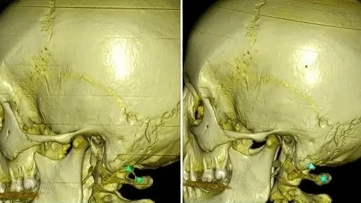 🏥 Нейрохирурги БСМП №1 успешно провели операции двум пациентам с редкой «аномалией Ким...
