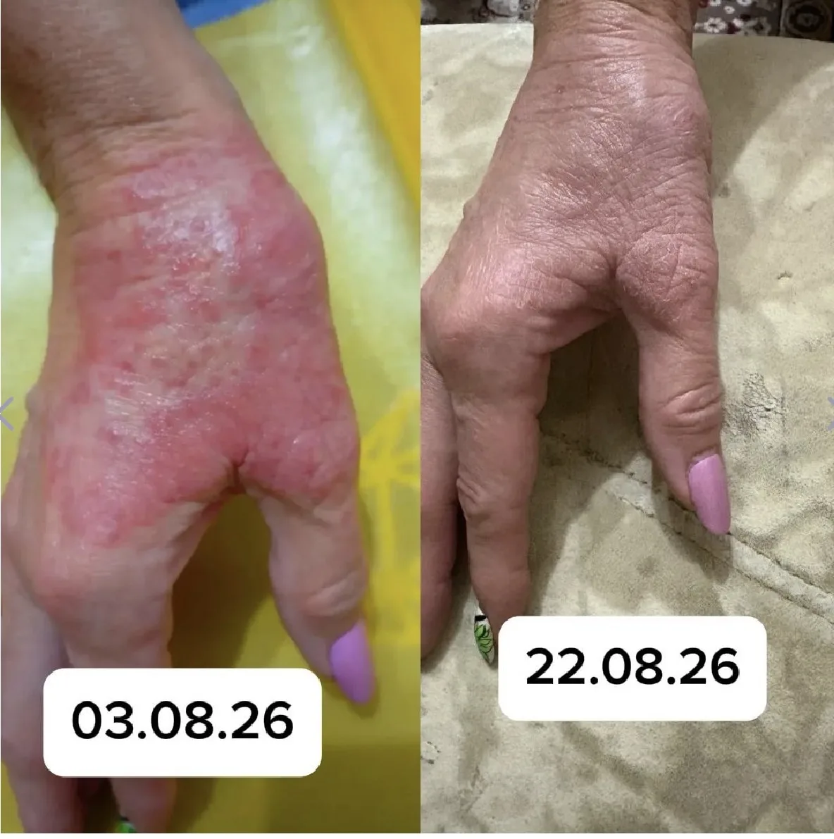 Это просто чудо, а не продукт! Была аллергическая реакция на руке, никакие антигистамин...