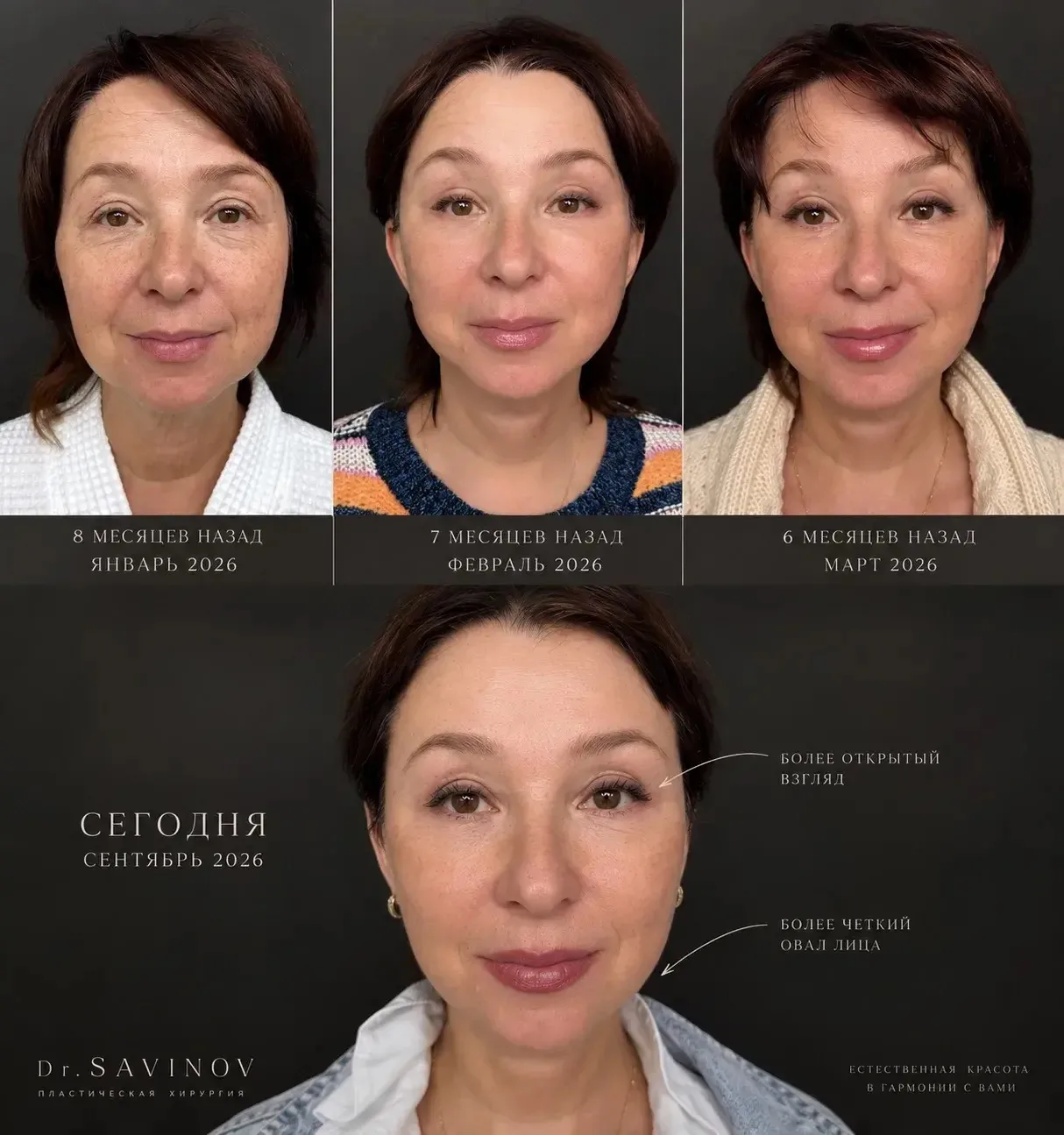 Тотальное омоложение спустя 8 месяцев 😍
