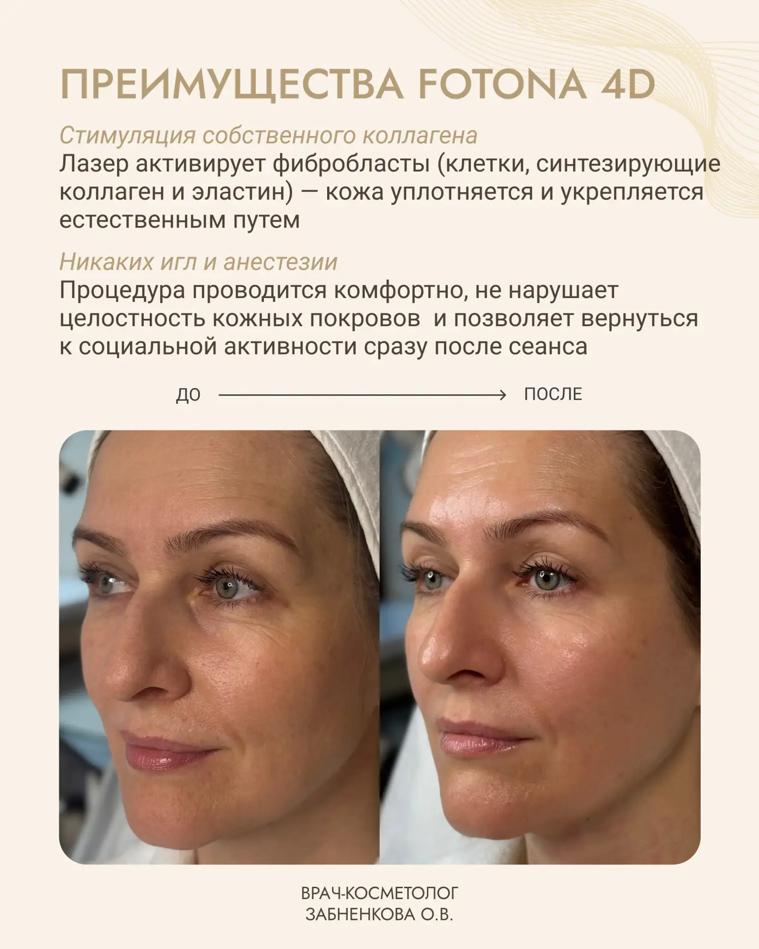 4-МЕРНОЕ ОМОЛОЖЕНИЕ FOTONA 4D: АЛЬТЕРНАТИВА ПЛАСТИЧЕСКОЙ ХИРУРГИИ