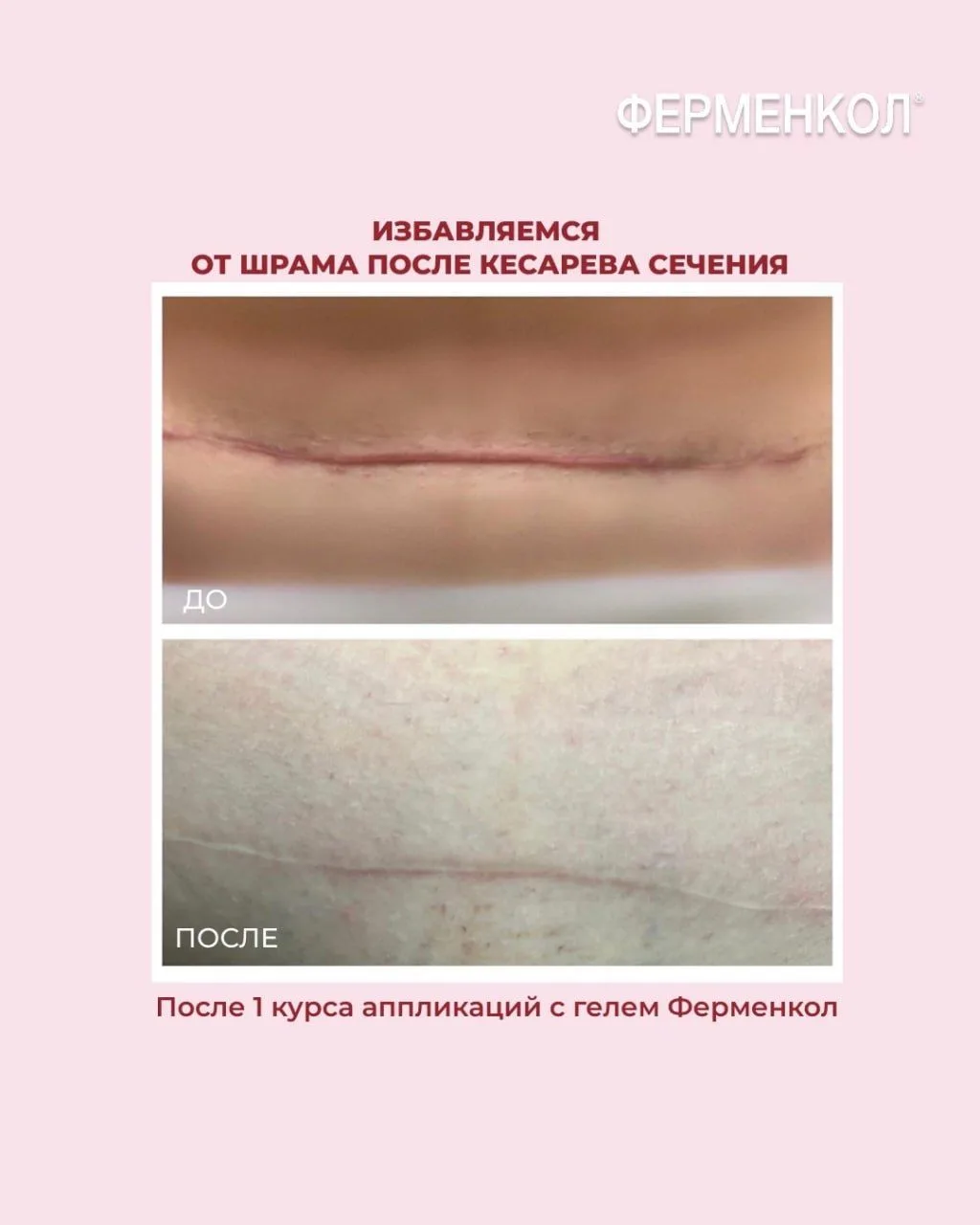 Шрам после кесарева мешает чувствовать себя уверенно?☹️