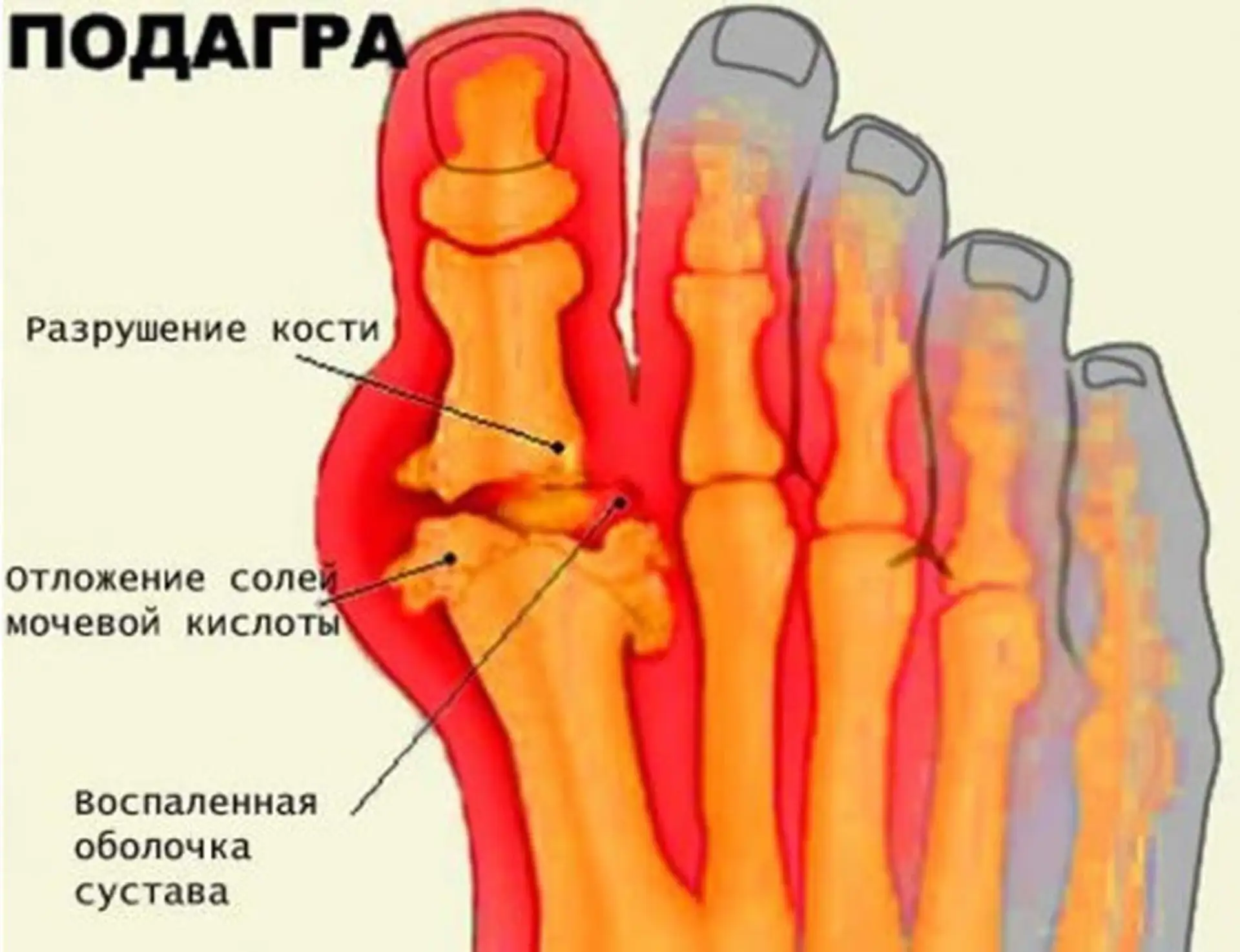 Как вывести из организма мочевую кислоту и предотвратить развитие подагры❓