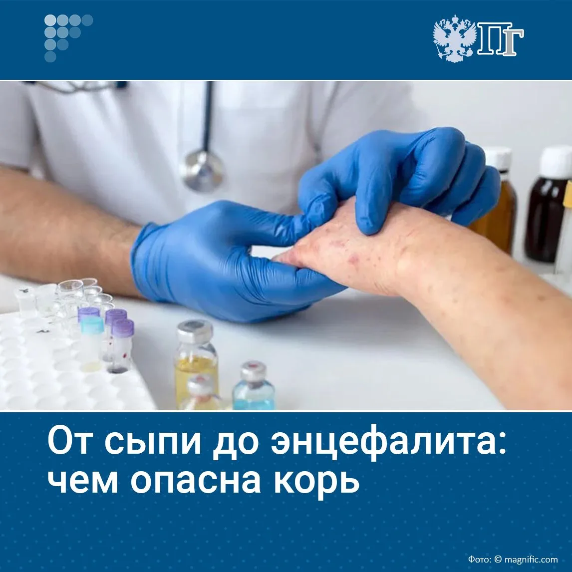 В 2023-2025 годах в России наблюдался подъем заболеваемости корью, пик которого пришелс...