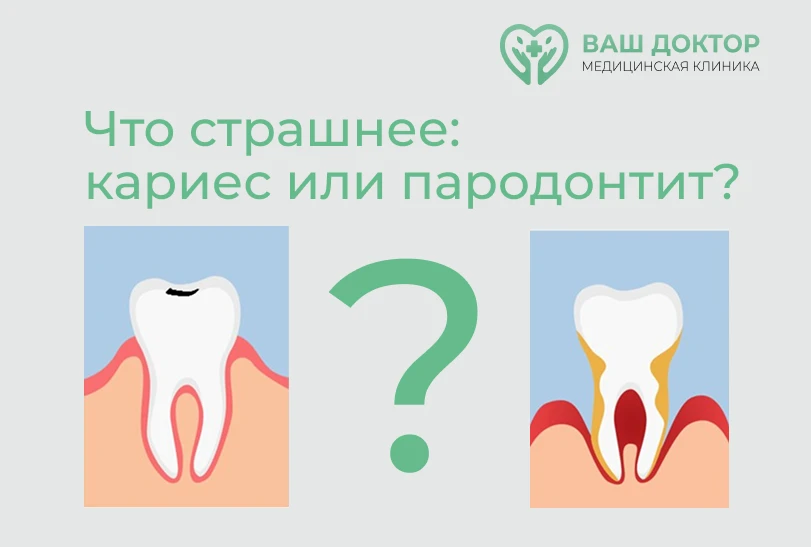 Кариес vs Пародонтит: кто опаснее? 🦷