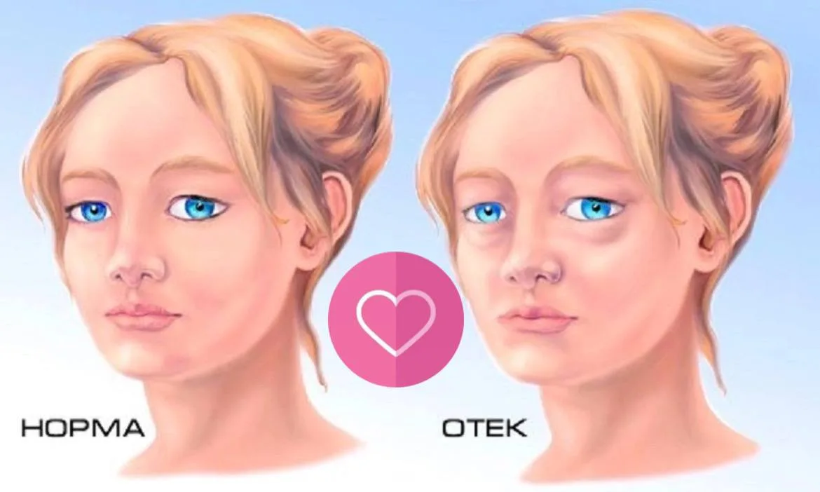 О чём пытается сказать отёк лица? ☄️
