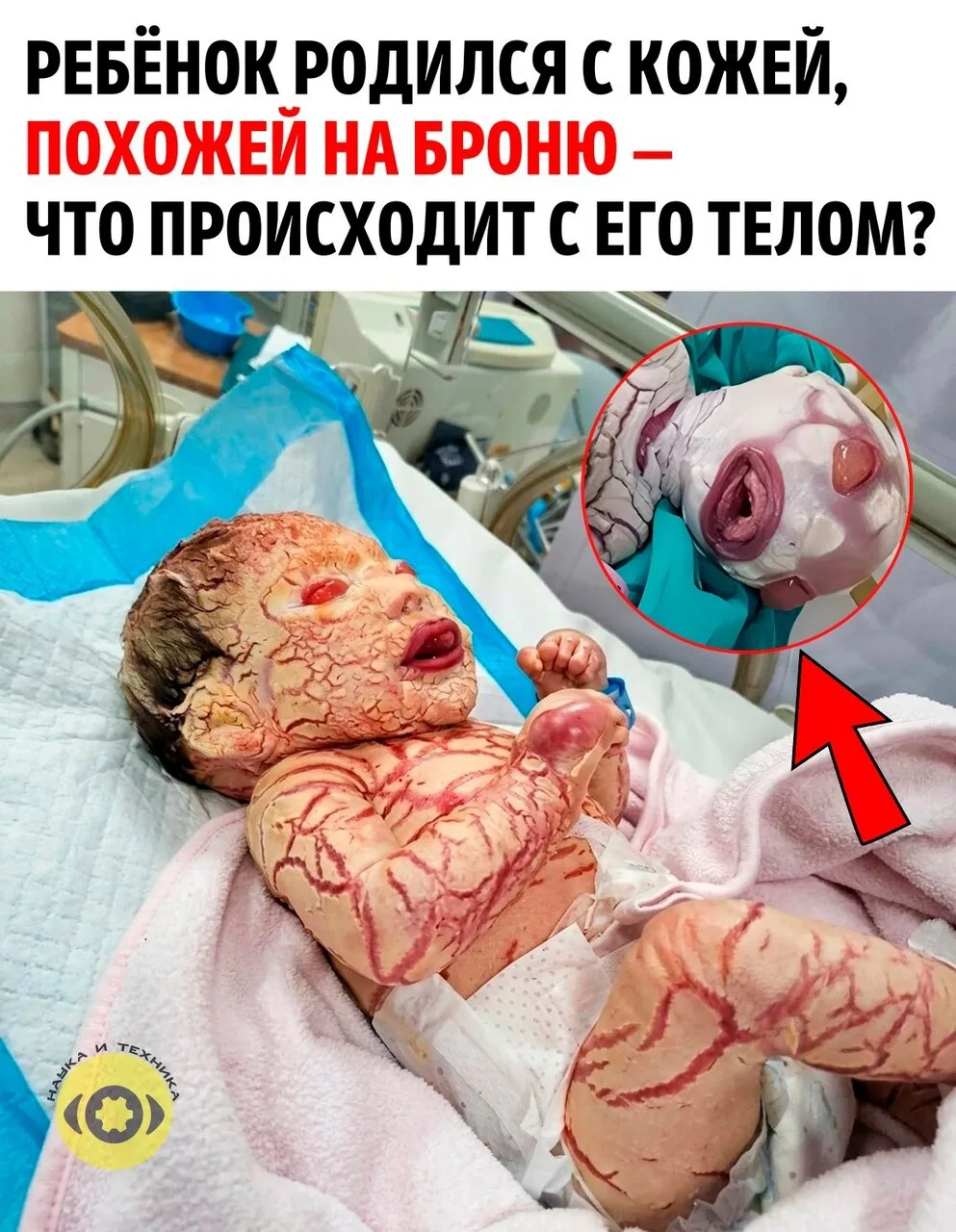 Ребёнок родился с кожей, похожей на броню — врачи столкнулись с редчайшим заболеванием