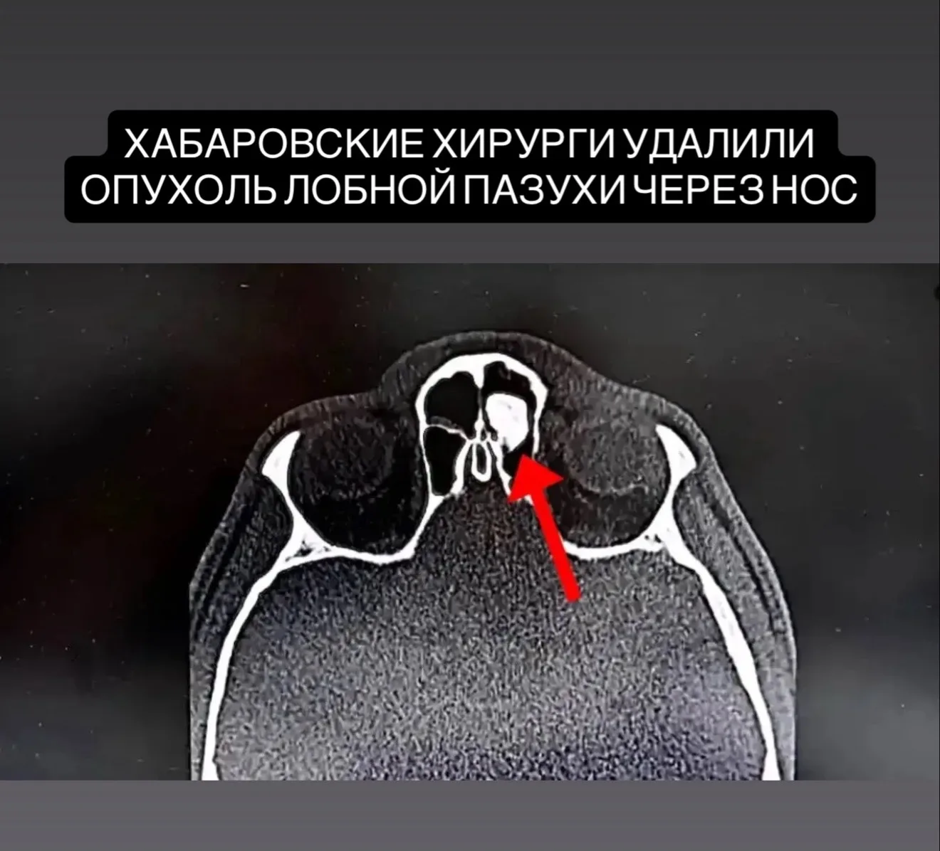Хабаровские хирурги удалили доброкачественную опухоль лобной пазухи через нос, без нару...