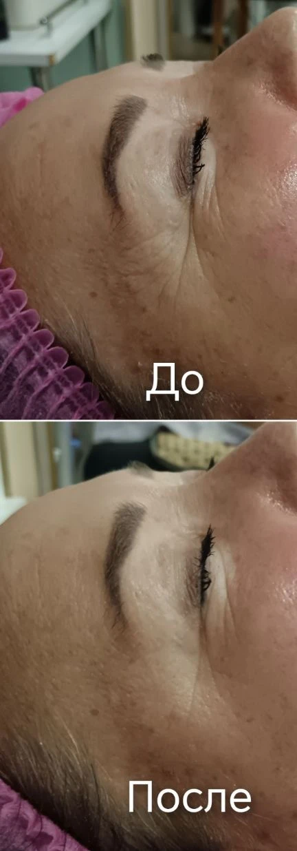 Жидкий лазер результат после 2 процедуры ❤️‍🔥💫❤️‍🔥💫❤️‍🔥