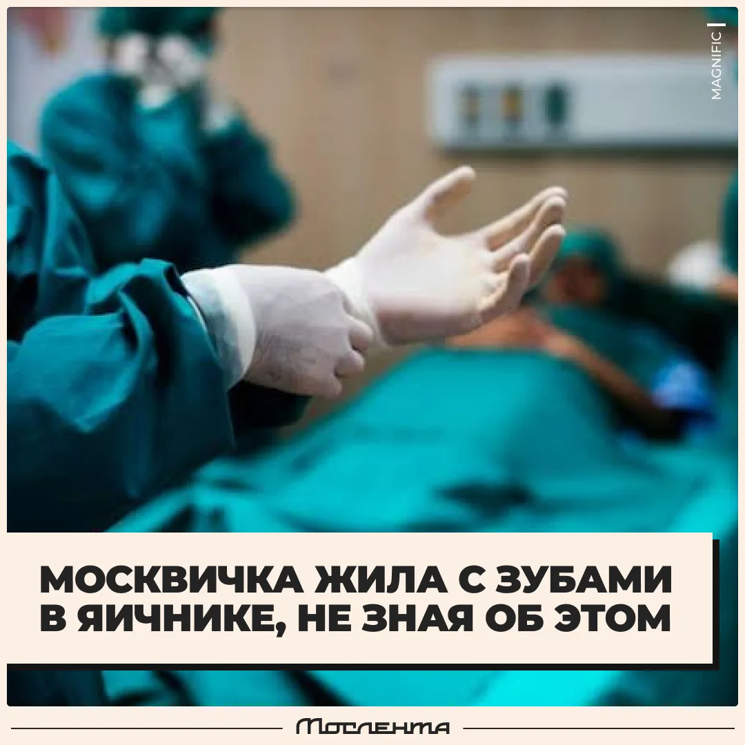 🦷 Столичные врачи удалили из яичника 25-летней москвички челюсть с зубами.