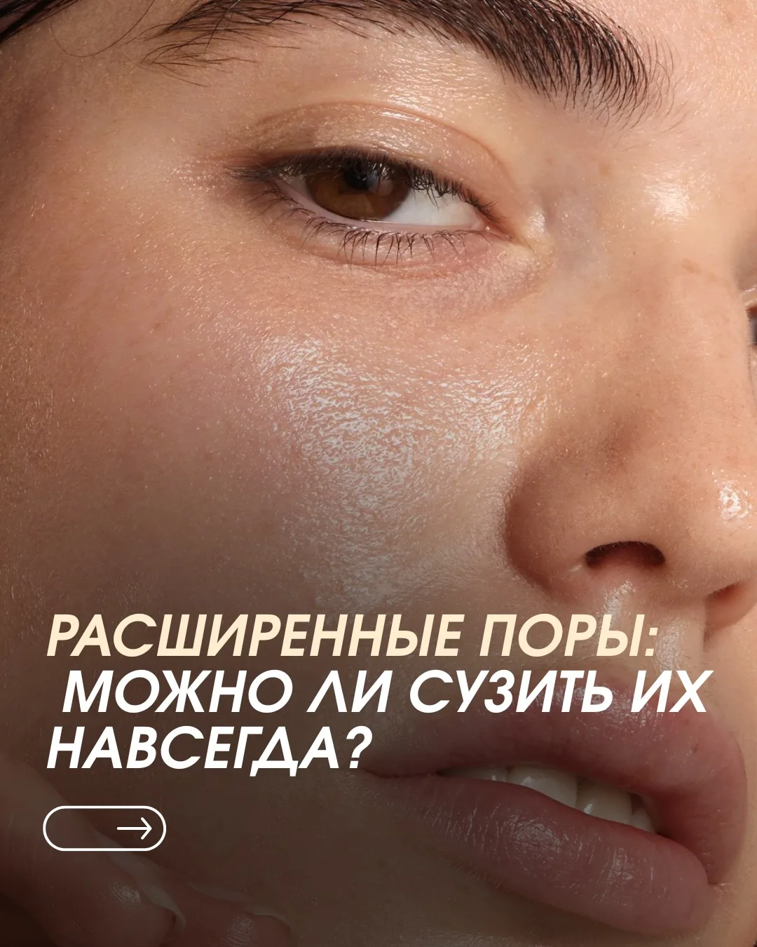 РАСШИРЕННЫЕ ПОРЫ: МОЖНО ЛИ СУЗИТЬ ИХ НАВСЕГДА?
