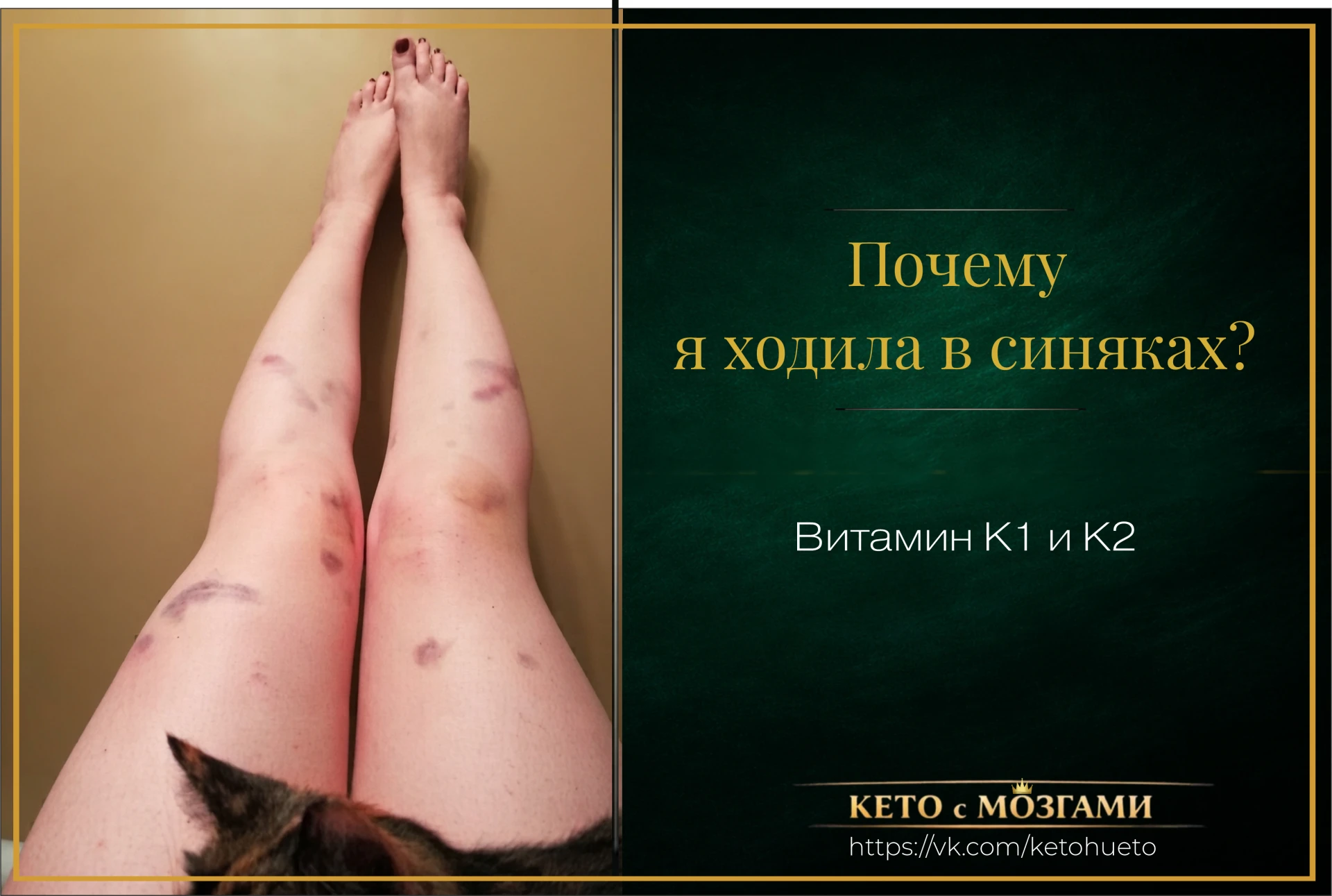 Почему я всё время ходила в синяках - и при чём тут витамин K