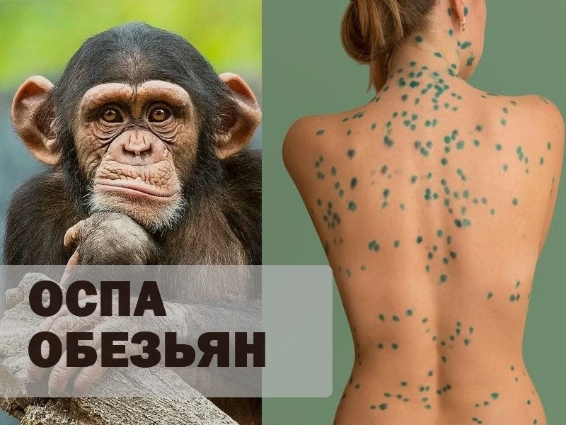 Пятерых человек с подозрением на оспу обезьян госпитализировали в Подмосковье.