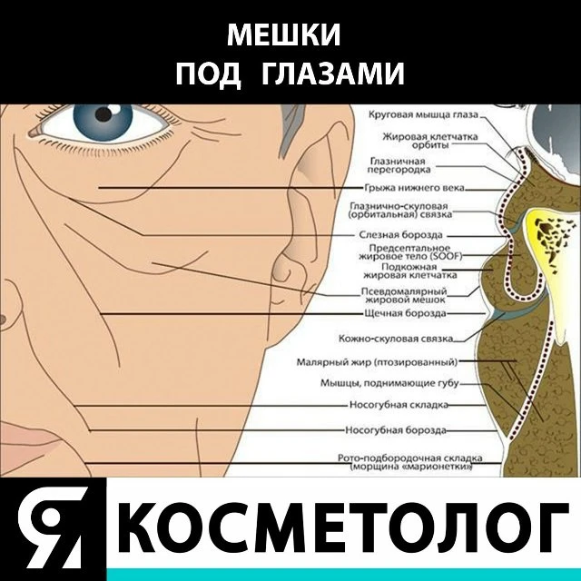 "Мешки" под под глазами. Причины возникновения.