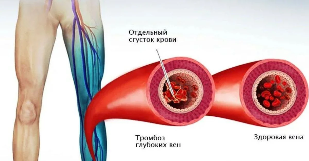 📌 Тромбоз вен – заболевание, при котором в венах образуются тромбы, препятствующие сво...