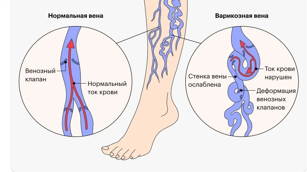 Варикоз на ногах — это не просто косметический дефект, а серьёзное заболевание вен.