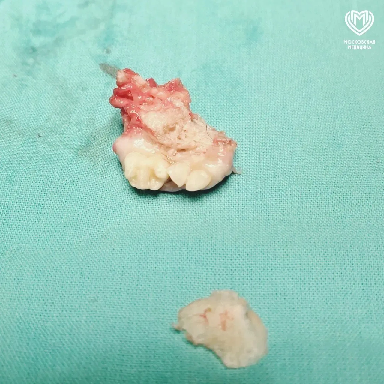 🦷 Челюсть с зубами выросла в яичнике 25-летней москвички.