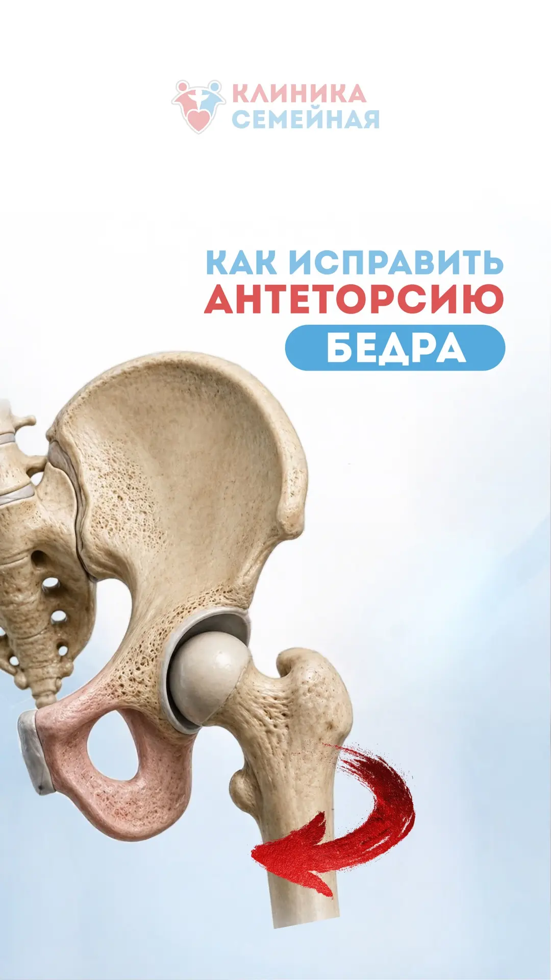 Упражнений для исправления антеторсии — много. Но работать нужно не со всеми.