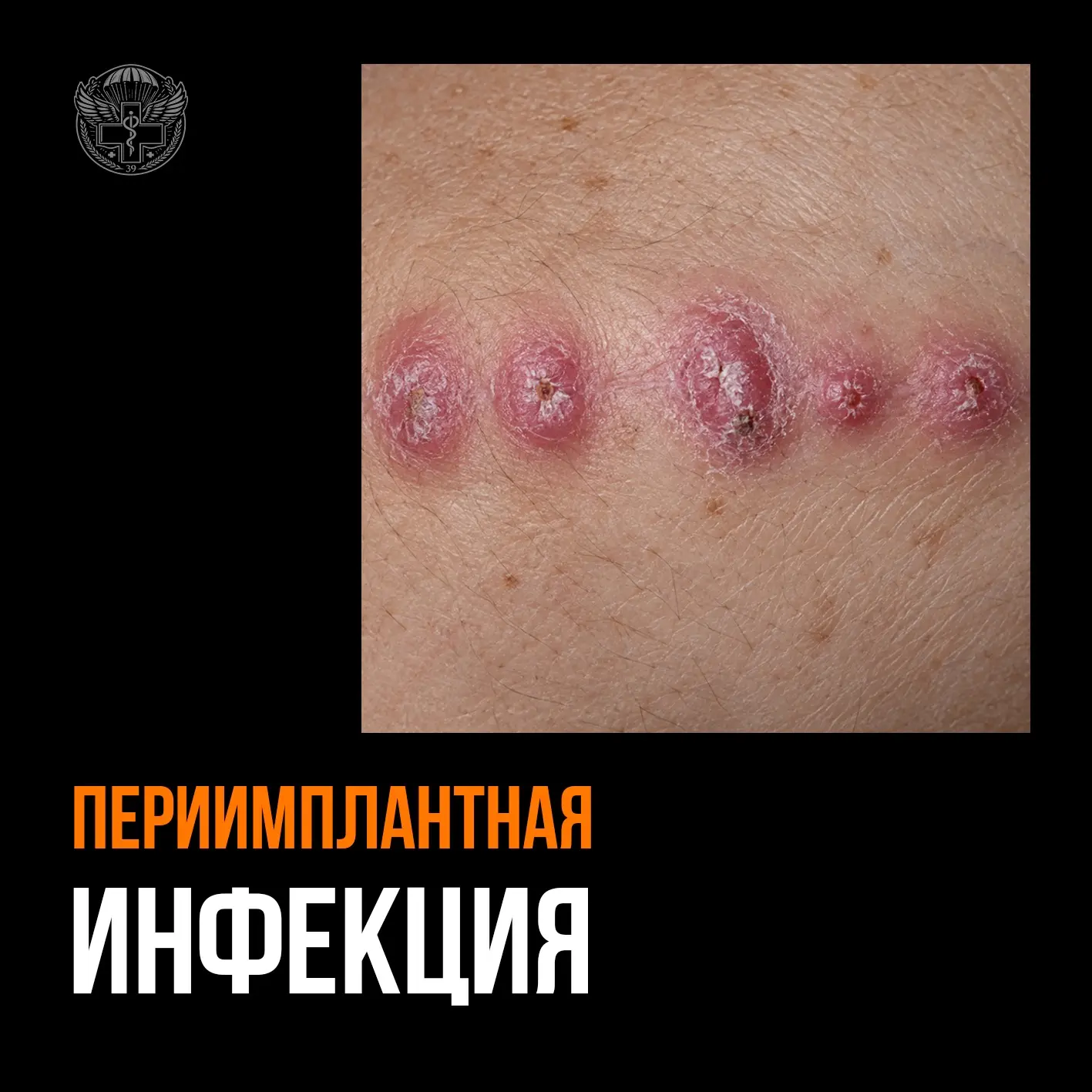 🪂 Имплант-ассоциированные инфекции: когда металл становится источником проблемы