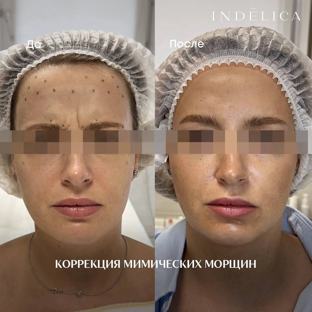 Ваше лицо каждый день повторяет тысячи мимических движений. Со временем на коже остаютс...