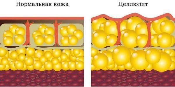 🍊 Что такое целлюлит на самом деле и что с ним делает баночный массаж?