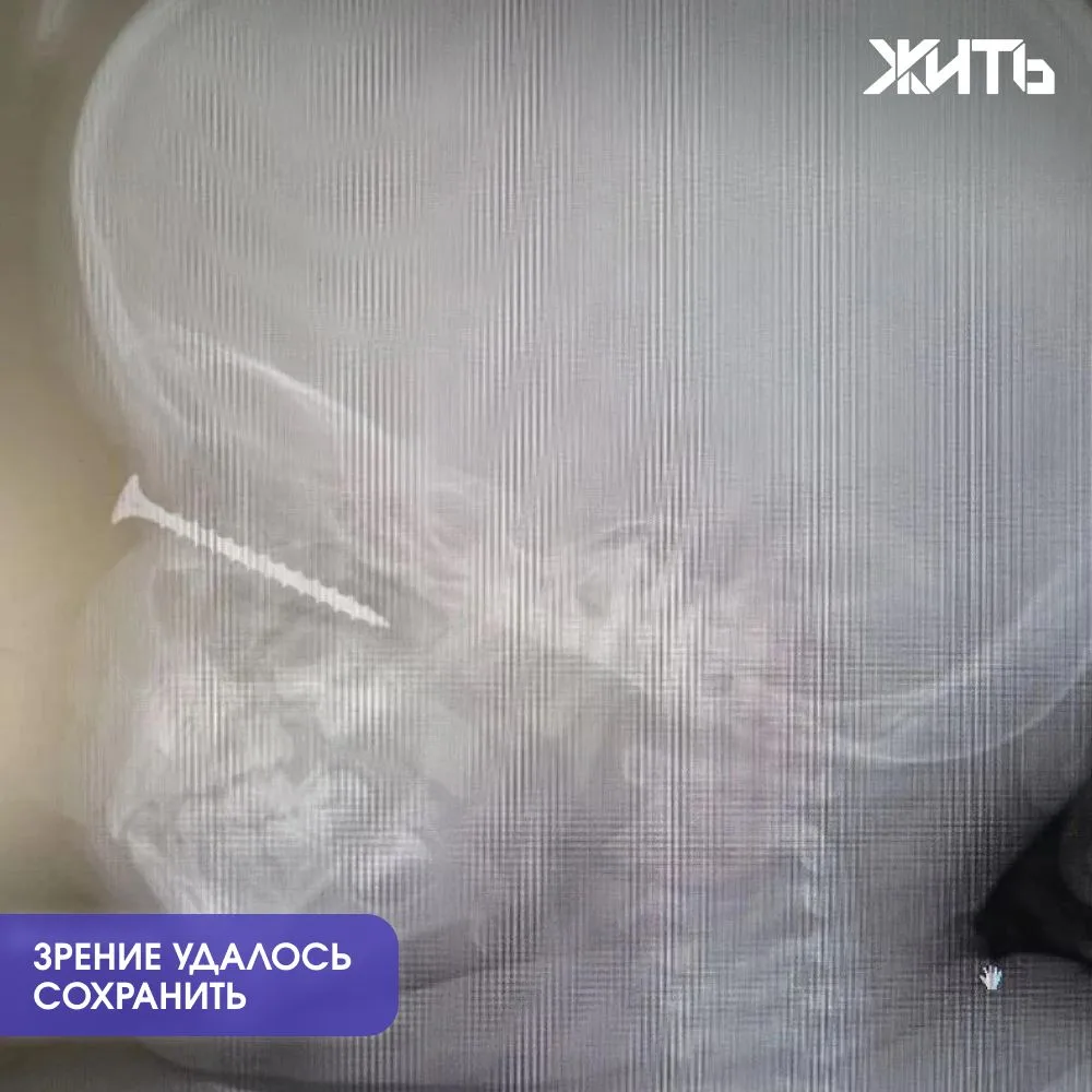 В Екатеринбурге врачи спасли зрение двухлетнему мальчику, удалив саморез