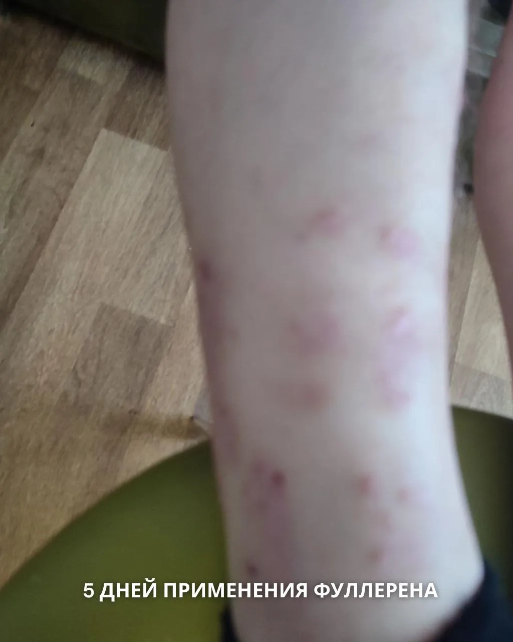 ✅ Хочу поделиться результатом по псориазу. Мой сын с 18 лет страдает псориазом. Чего мы...