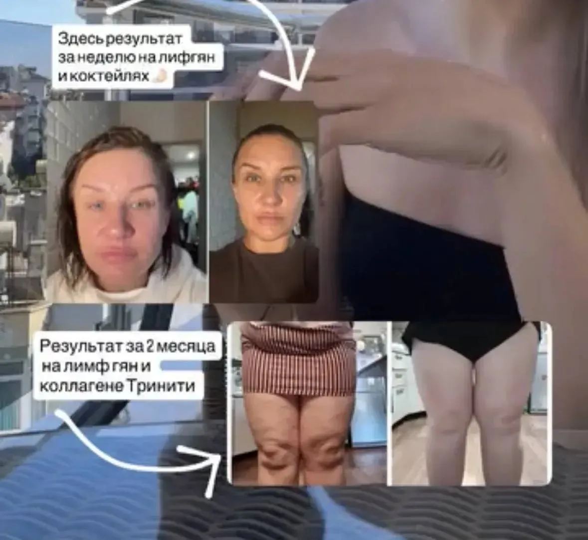 Еще один классный результат с коллагеном и лимф гяном🔥