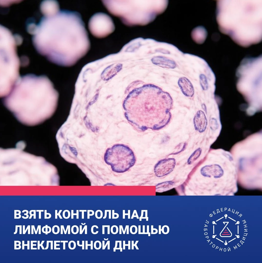 🔬 Внеклеточная ДНК может помочь оценивать эффективность лечения лимфомы