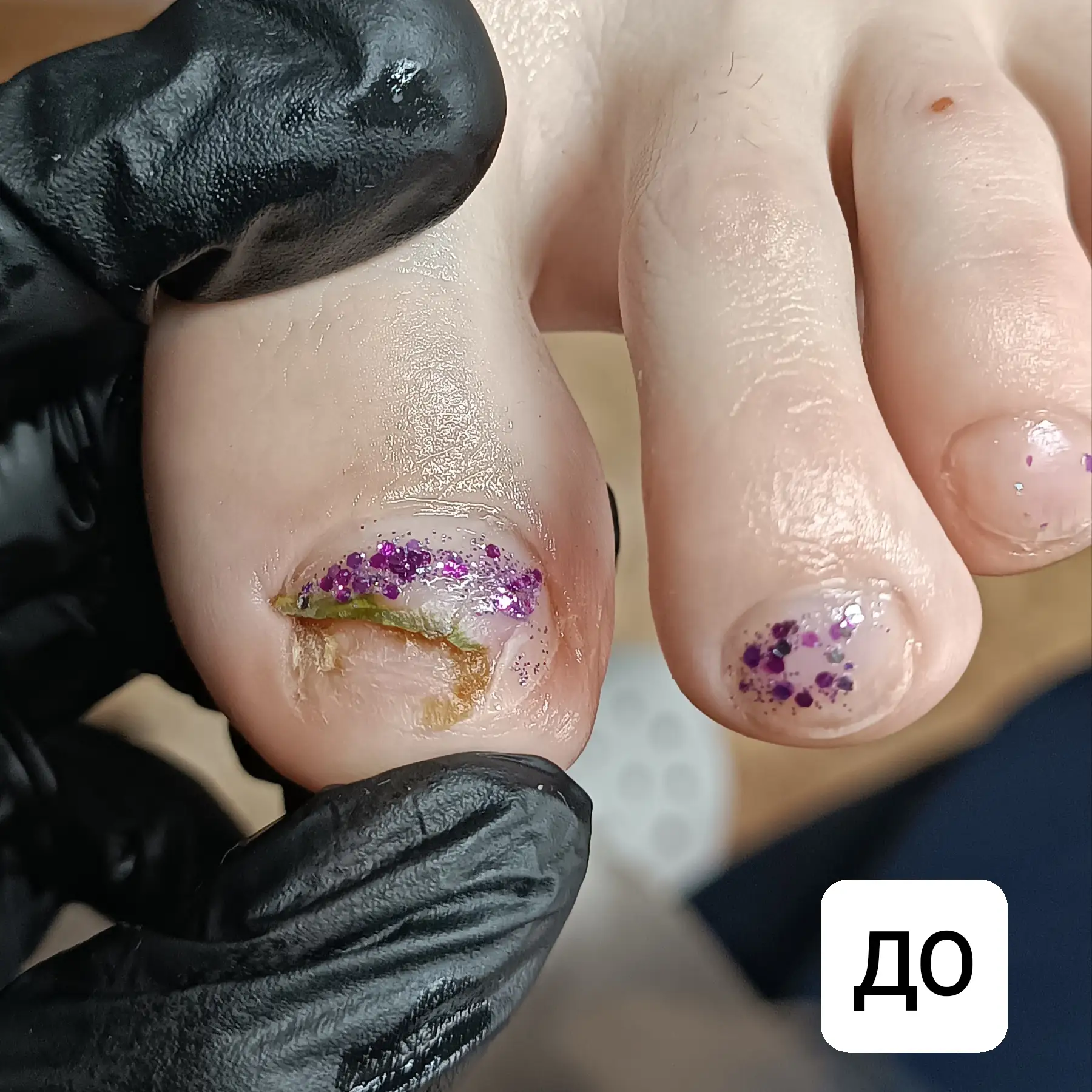 Синегнойная палочка: до и после подологической обработки 💚