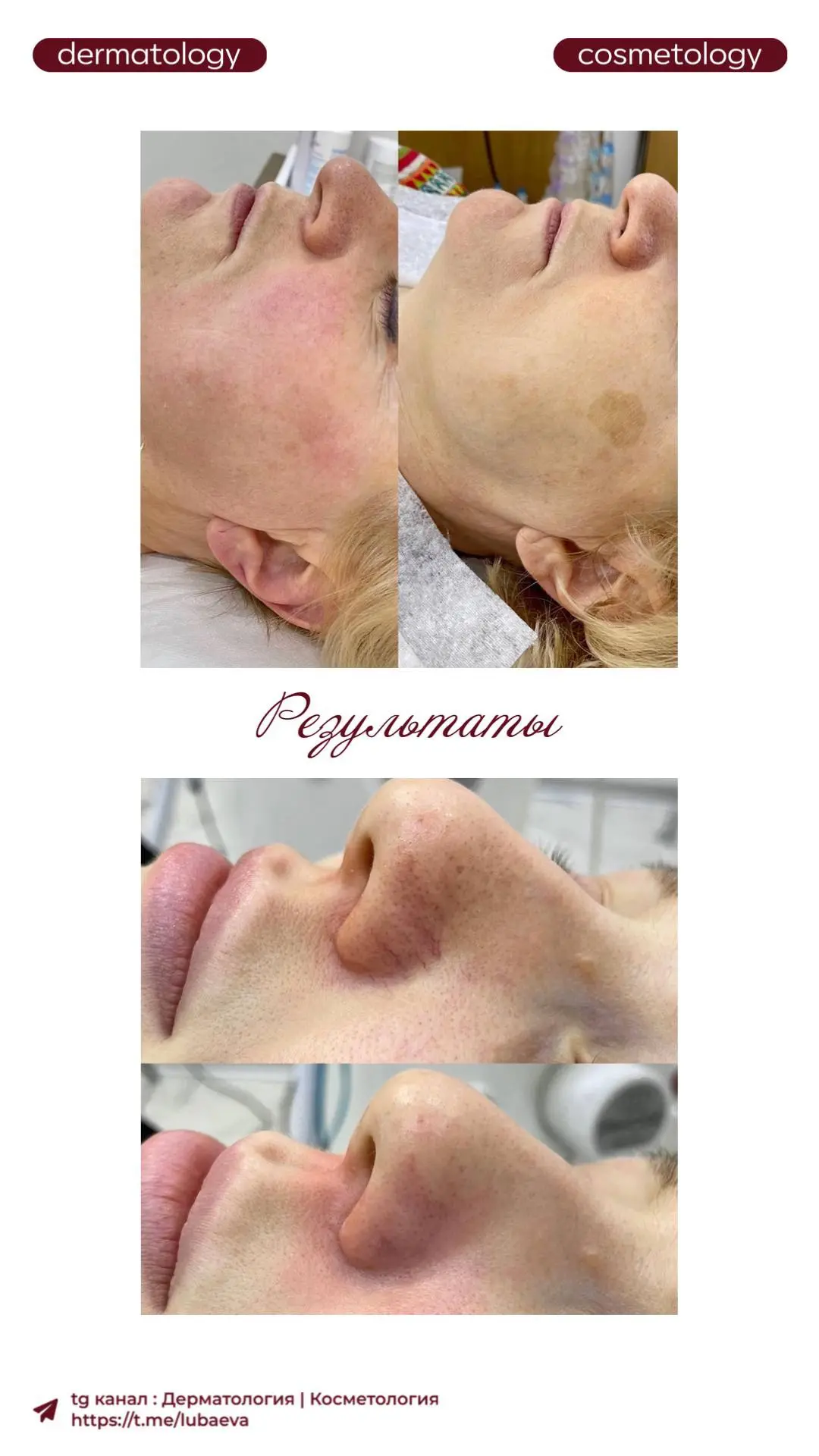 ✨ IPL-терапия на аппарате InMode — умный свет для красивой кожи ✨