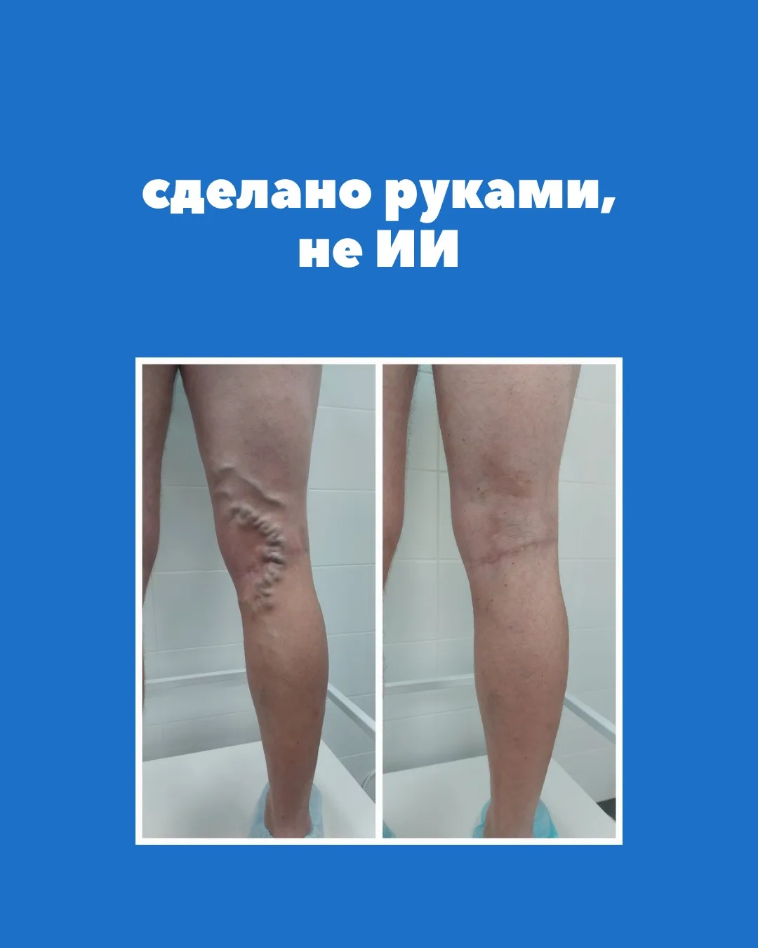 На фото — реальный результат лечения у флеболога: без генерации, без «идеальной картинк...