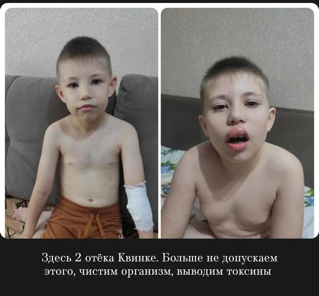 Отек Квинке у ребенка 🥹