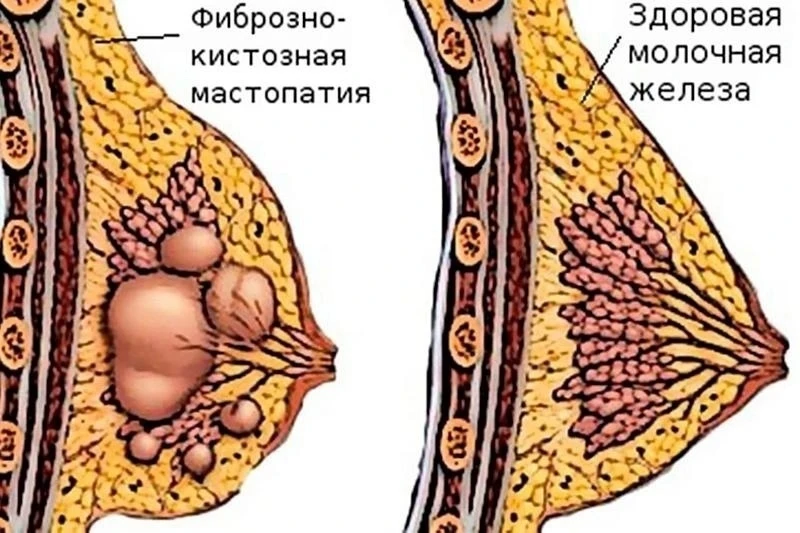 ОТ МАСТОПАТИИ есть шикарное средство 🔥
