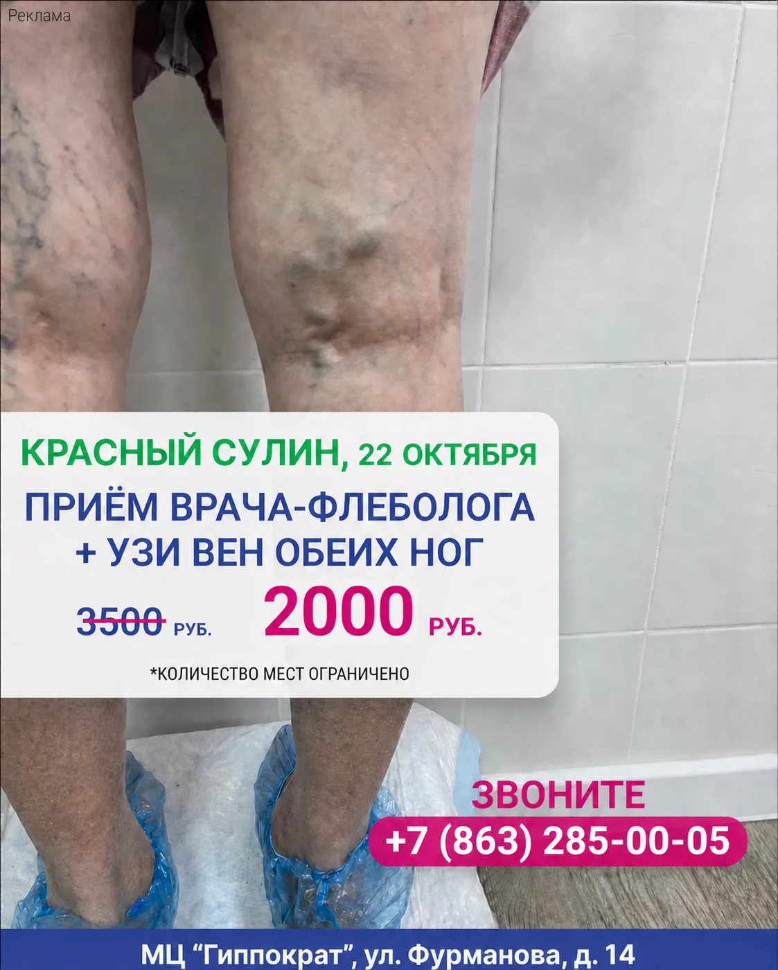 Приём врача-флеболога + УЗИ вен обеих ног всего за 2000 рублей! (вместо 3500р)
