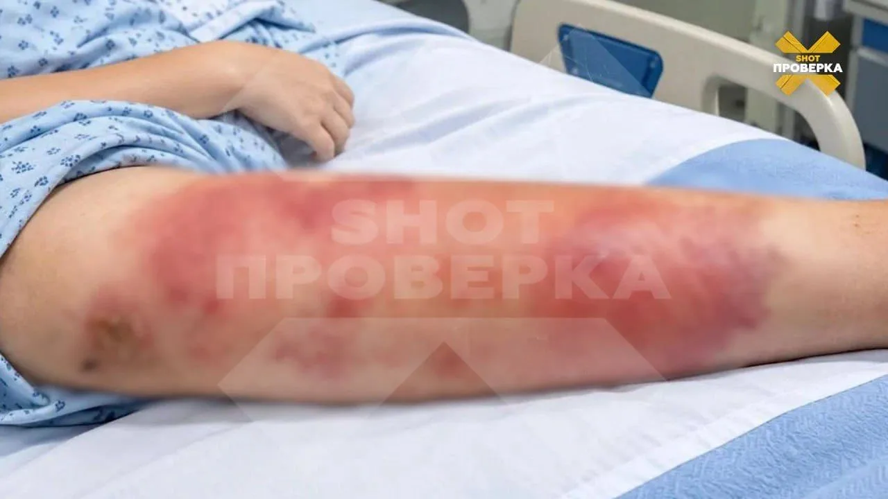 🏥 Двух девочек госпитализировали в Пушкино с рожистым воспалением после обычных ссадин...