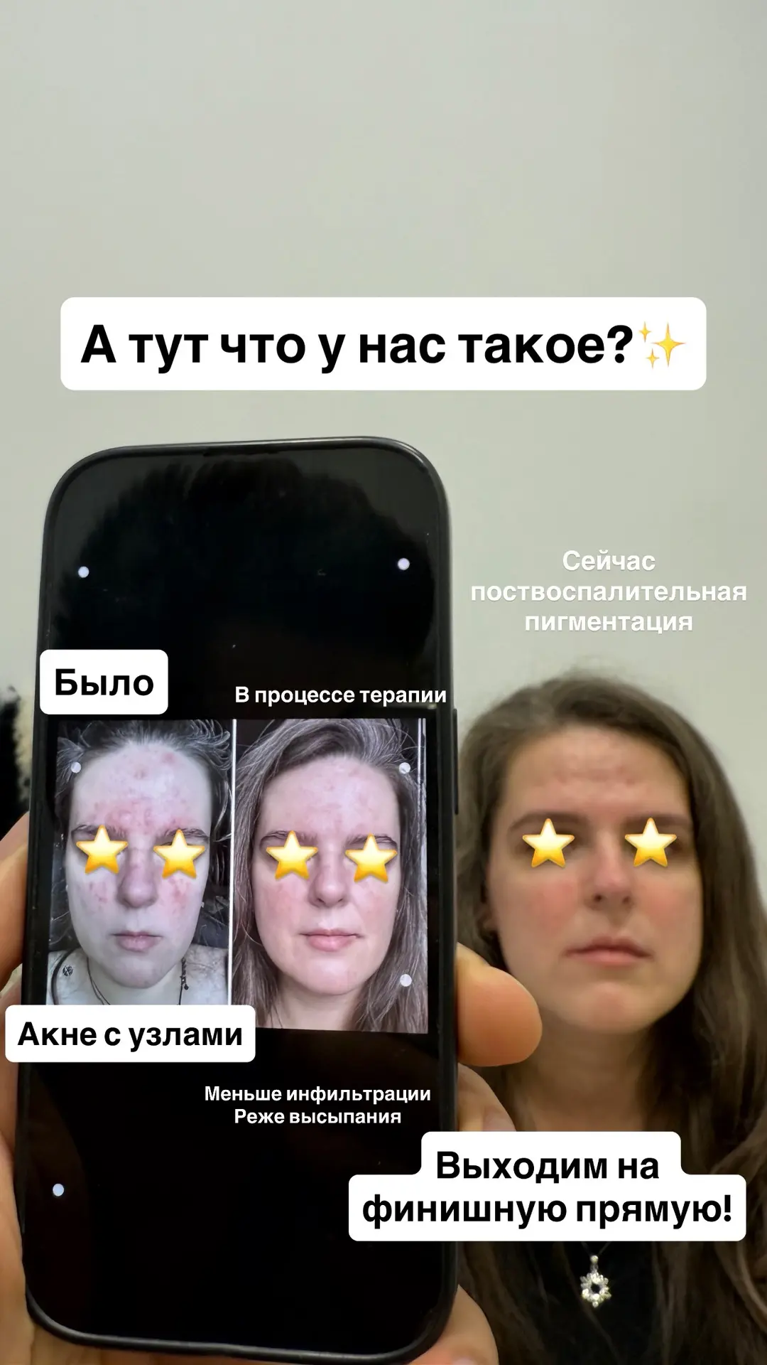 Акне не спиди-гонщик!