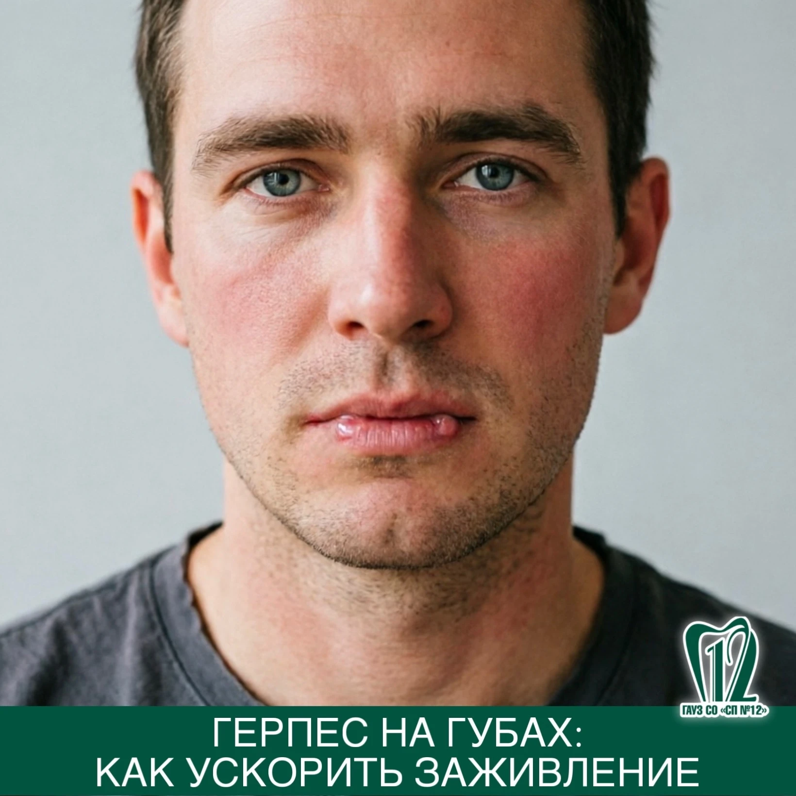 Герпес на губах: как ускорить заживление.