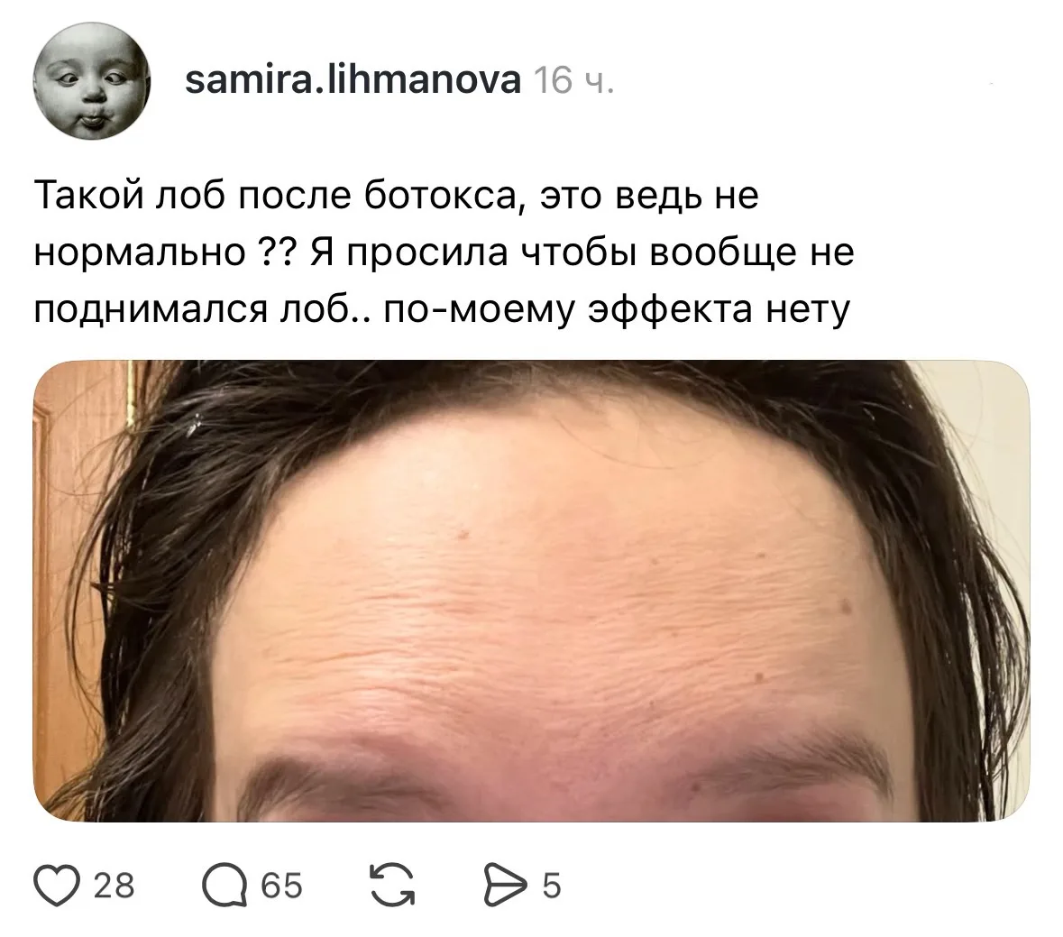 Принесла вам задачку со звездочкой: на фото — нормальный эффект от ботокса или нет?