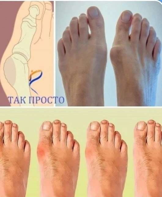 🌟5 ЭФФЕКТИВНЫХ СПОСОБОВ ИЗБАВИТЬСЯ ОТ КОСТОЧКИ НА НОГЕ БЕЗ ХИРУРГИИ