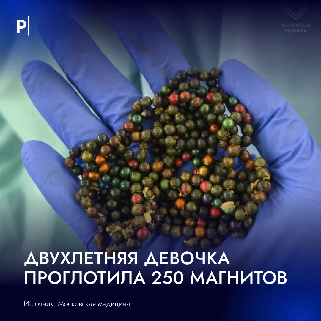 🧲 250 магнитных шариков достали из желудка двухлетней девочки в Москве.