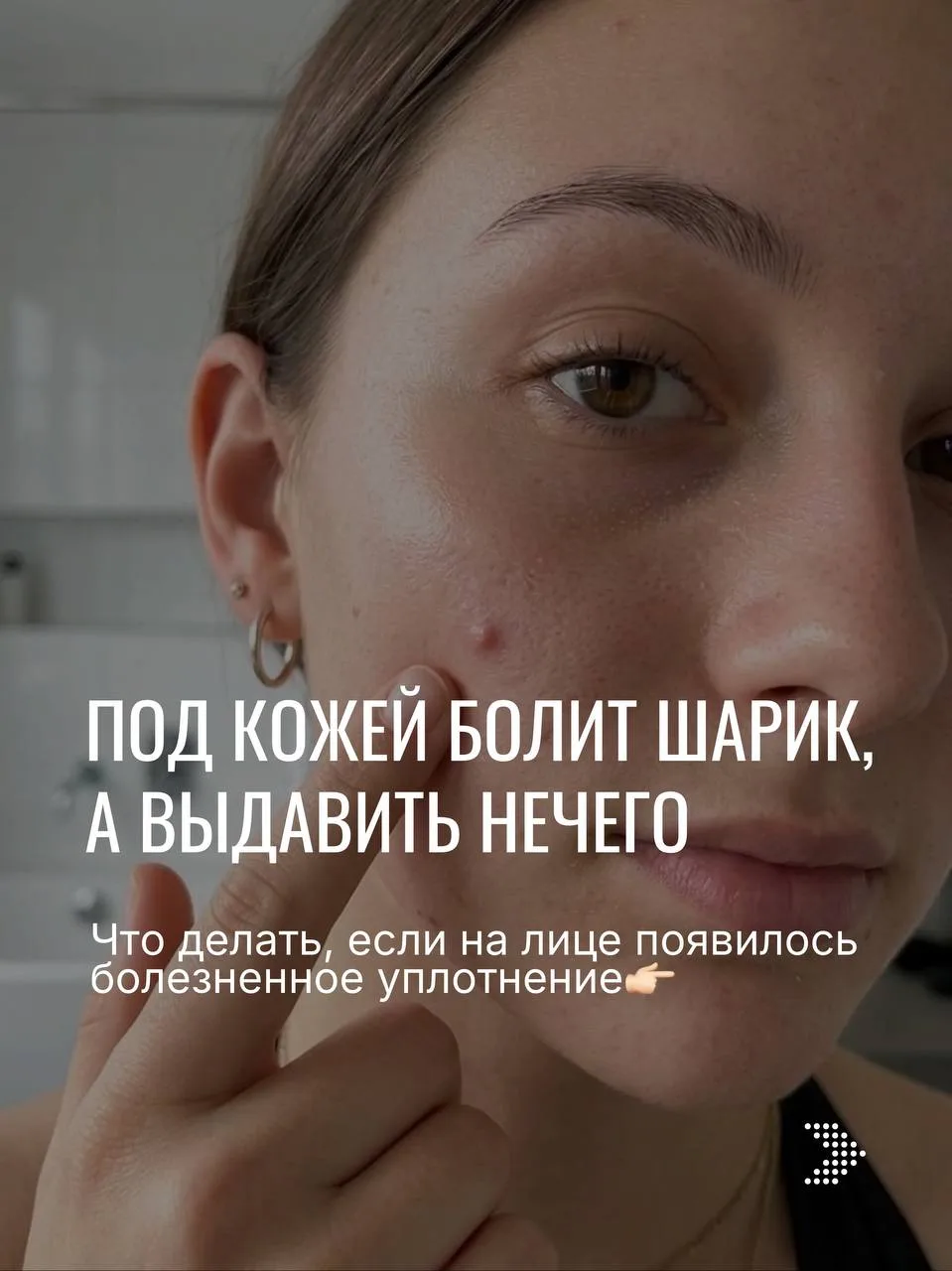 ВЫ УВЕРЕНЫ, ЧТО ЭТО ПРЫЩ? ТОГДА ПОЧЕМУ ПОСЛЕ «ВЫДАВЛИВАНИЯ» СТАНОВИТСЯ ТОЛЬКО ХУЖЕ?
