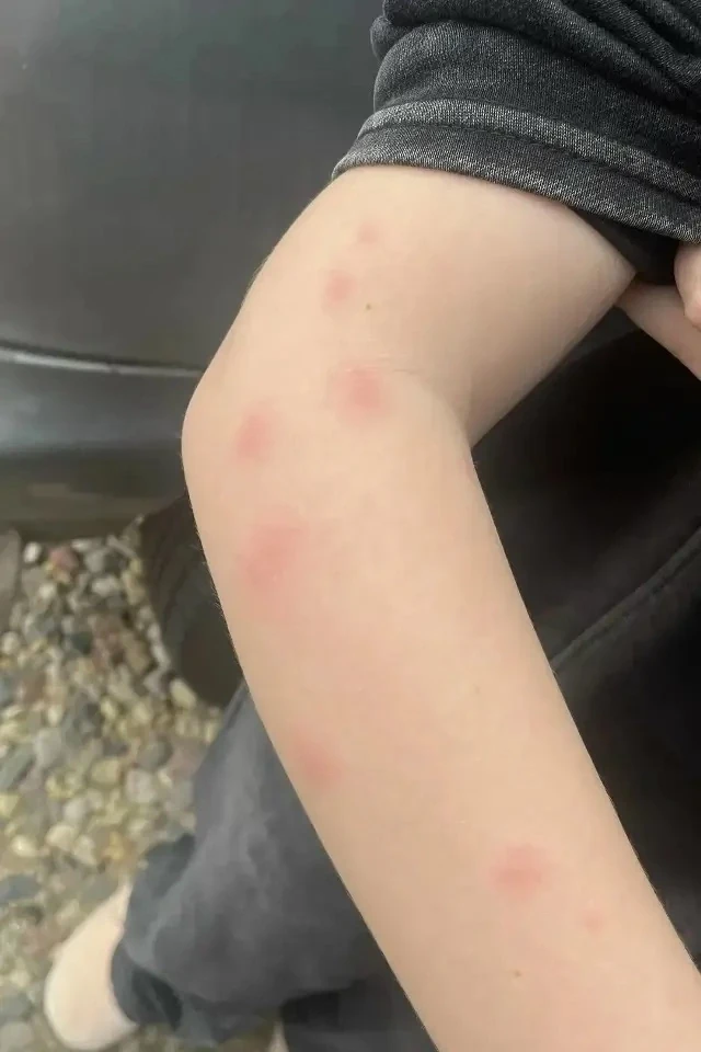 😱😱😱 Юную костромичку покусали во время лечения в больнице