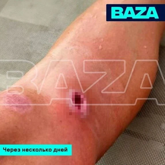 📰 У уроженки Татарстана образовался «кратер» на месте укуса комара