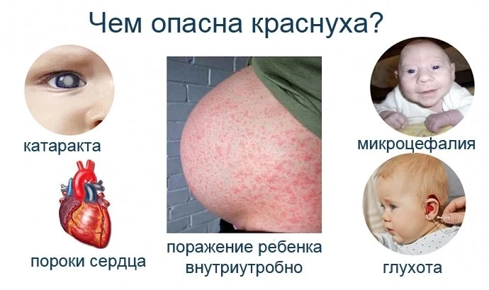 🔴 Краснуха: что нужно знать!