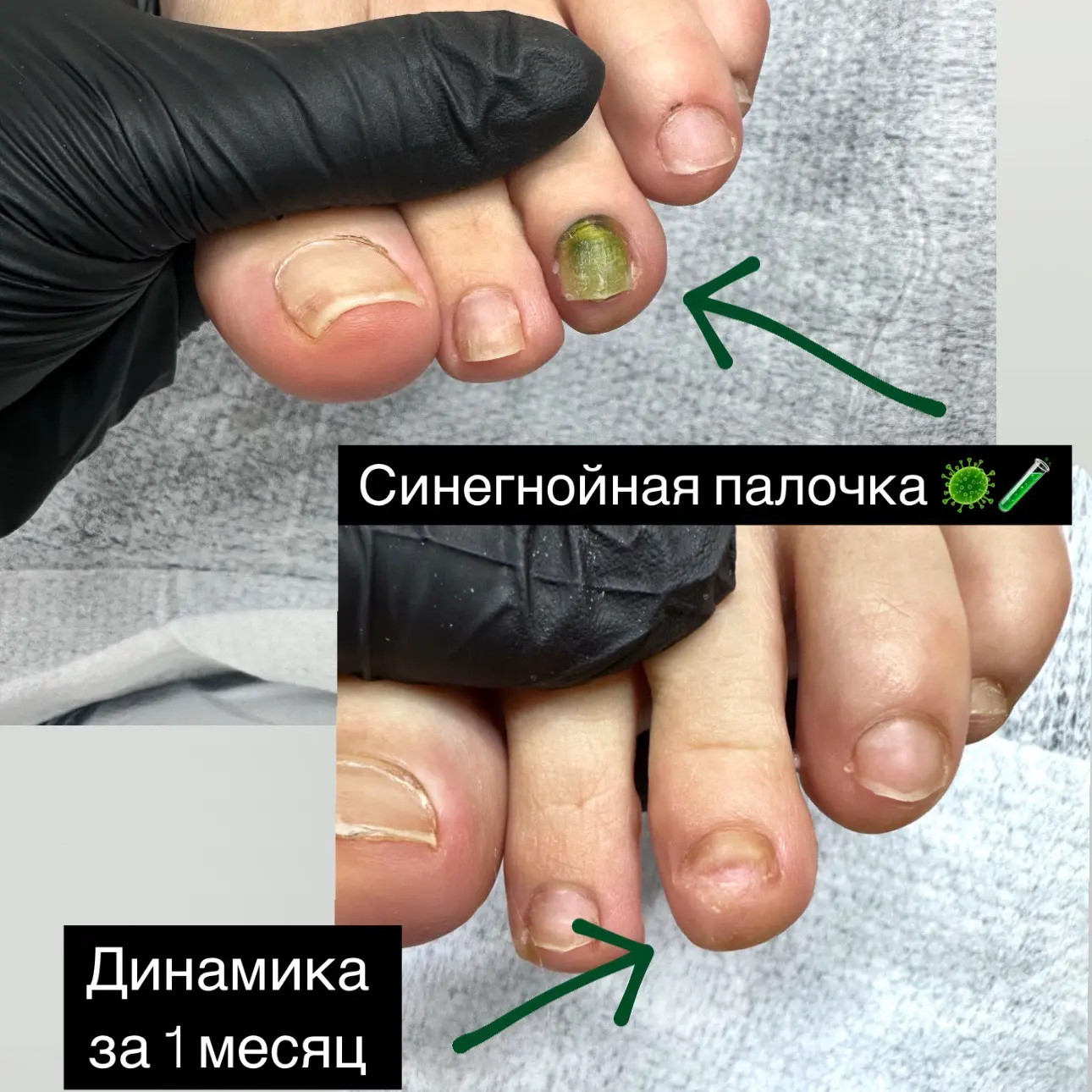 🌊 Синегнойка вместо сувенира с моря